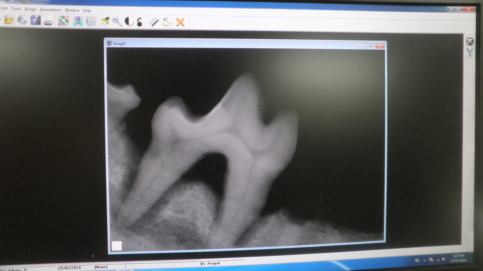 Dental X-Ray Room!Why need Dental X-Rays!